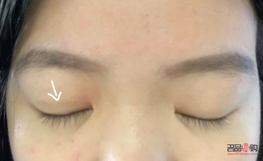 腫眼泡按摩能否有效消除？