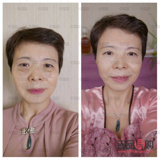 <h3>豹紋媽媽去掉眼袋價格探究</h3>