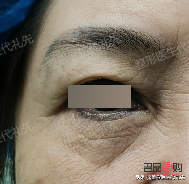 眼袋手術(shù)后的疤痕問題：能否自動消掉？