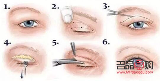 做眼部綜合手術(shù)注意事項(xiàng)(做眼部綜合手術(shù)注意事項(xiàng)有哪些)