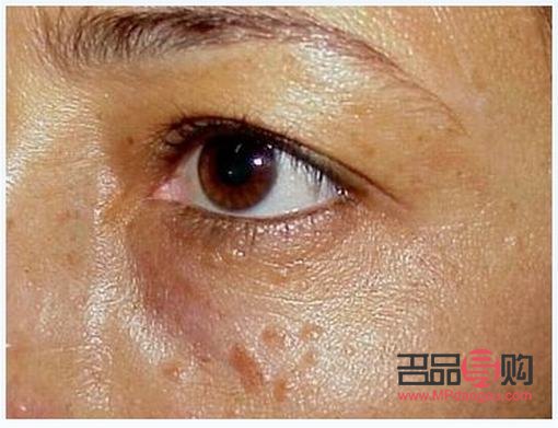 美容院去汗管瘤嗎(美容院去汗管瘤嗎有風(fēng)險嗎)