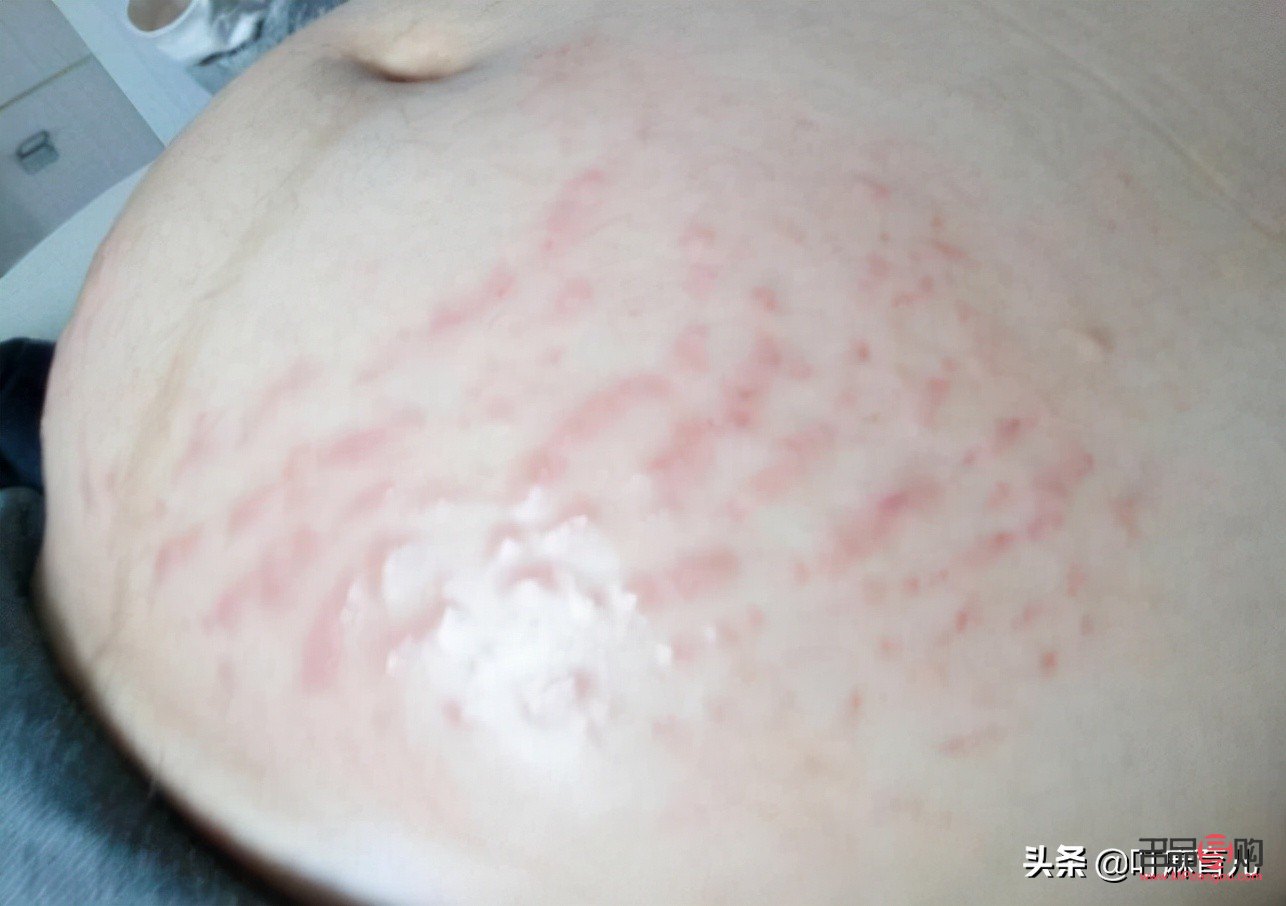 孕婦身體長紋怎么護理(孕婦身上長紋)