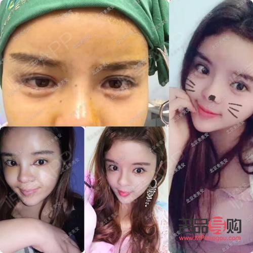 <h3>開完眼角是否能恢復(fù)到以前？</h3>