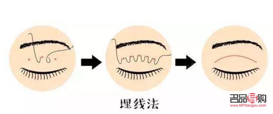 定點(diǎn)埋線雙眼皮能維持幾年(定點(diǎn)埋線雙眼皮能維持幾年呢)