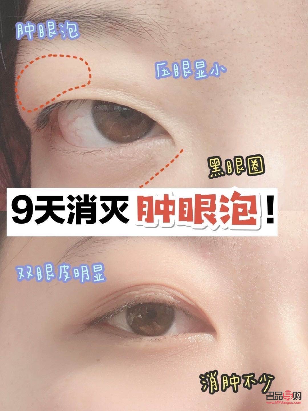 腫眼泡除了手術還有什么辦法(腫眼泡除了手術還有什么辦法消腫)