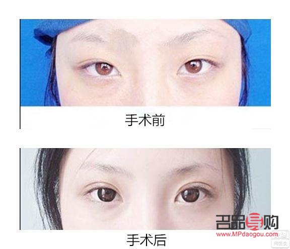 割雙眼皮大概多久可以出門(割雙眼皮大概多久可以出門散步)