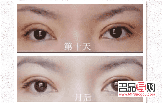 割雙眼皮大概多久可以出門(割雙眼皮大概多久可以出門散步)