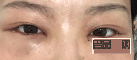 <h3>內(nèi)切去眼袋手術(shù)后的恢復(fù)時(shí)間及注意事項(xiàng)</h3>