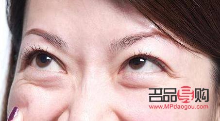 <h3>內(nèi)切去眼袋手術(shù)后的恢復(fù)時(shí)間及注意事項(xiàng)</h3>