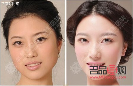 上眼皮松弛適合做什么樣的雙眼皮(上眼皮松弛適合做什么樣的雙眼皮呢)