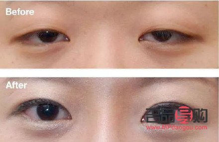 上眼皮松弛適合做什么樣的雙眼皮(上眼皮松弛適合做什么樣的雙眼皮呢)