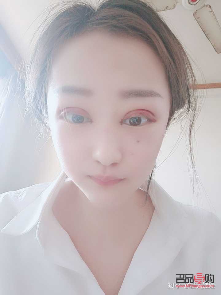 割雙眼皮多久恢復(fù)自然(割雙眼皮多久恢復(fù)自然呢)