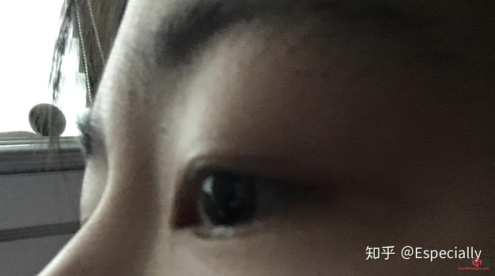 魚泡眼用什么藥消腫效果好(魚泡眼用什么藥消腫效果好一點)