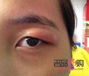 魚泡眼用什么藥消腫效果好(魚泡眼用什么藥消腫效果好一點)