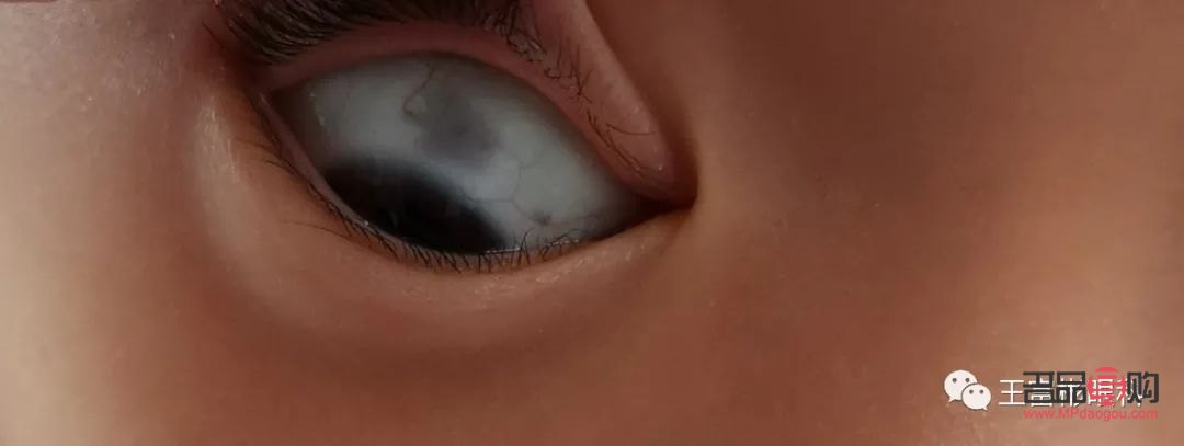 眼睛白色部分有黑色斑塊(兒童眼睛白色部分有黑色斑塊)