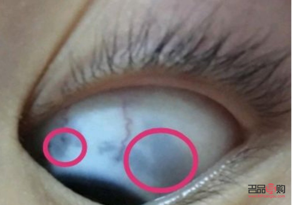眼睛白色部分有黑色斑塊(兒童眼睛白色部分有黑色斑塊)