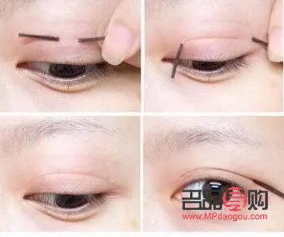 <h3>雙眼皮手術(shù)失敗類型詳解</h3>