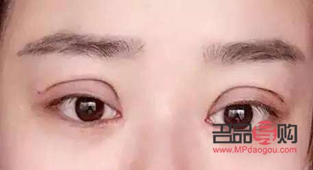 開眼角手術(shù)一般需要多久恢復(fù)自然(開眼角手術(shù)一般需要多久恢復(fù)自然圖片)