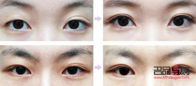 50歲還能做雙眼皮修復(fù)手術(shù)嗎(50歲還能做雙眼皮修復(fù)手術(shù)嗎視頻)