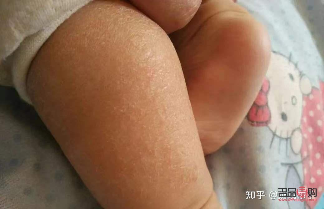 寶寶身體干燥怎么護(hù)理(寶寶身體干燥怎么護(hù)理最好)