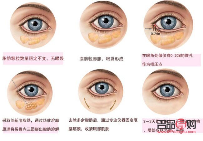 美容院眼袋怎么去(美容院眼袋怎么去除最有效)