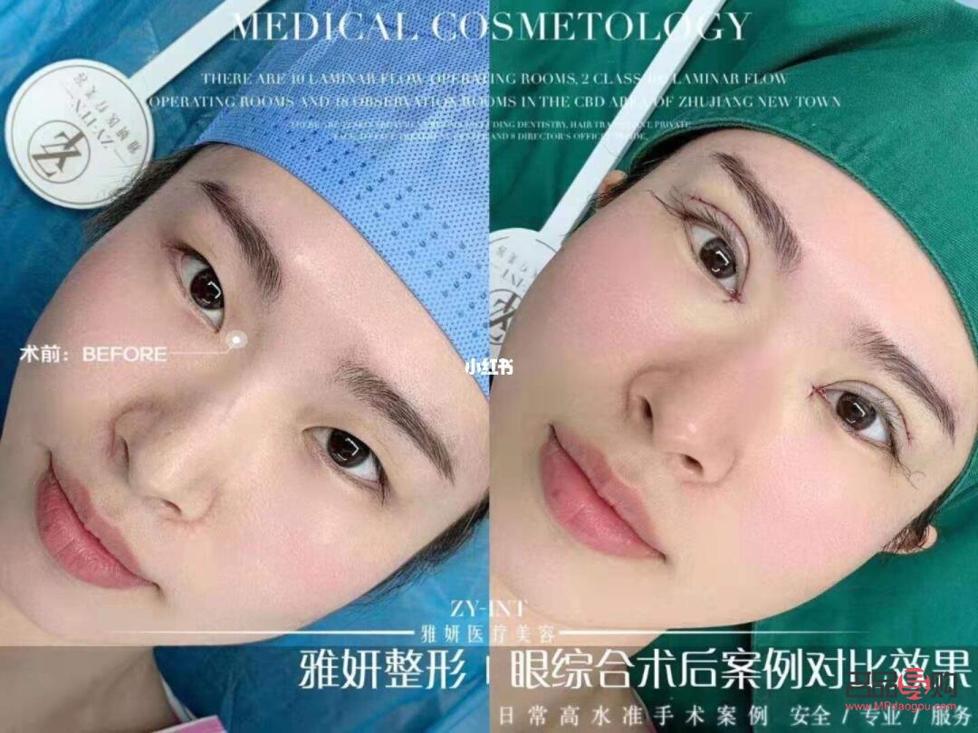 眼綜合真的好看嗎(眼綜合值得做嗎)