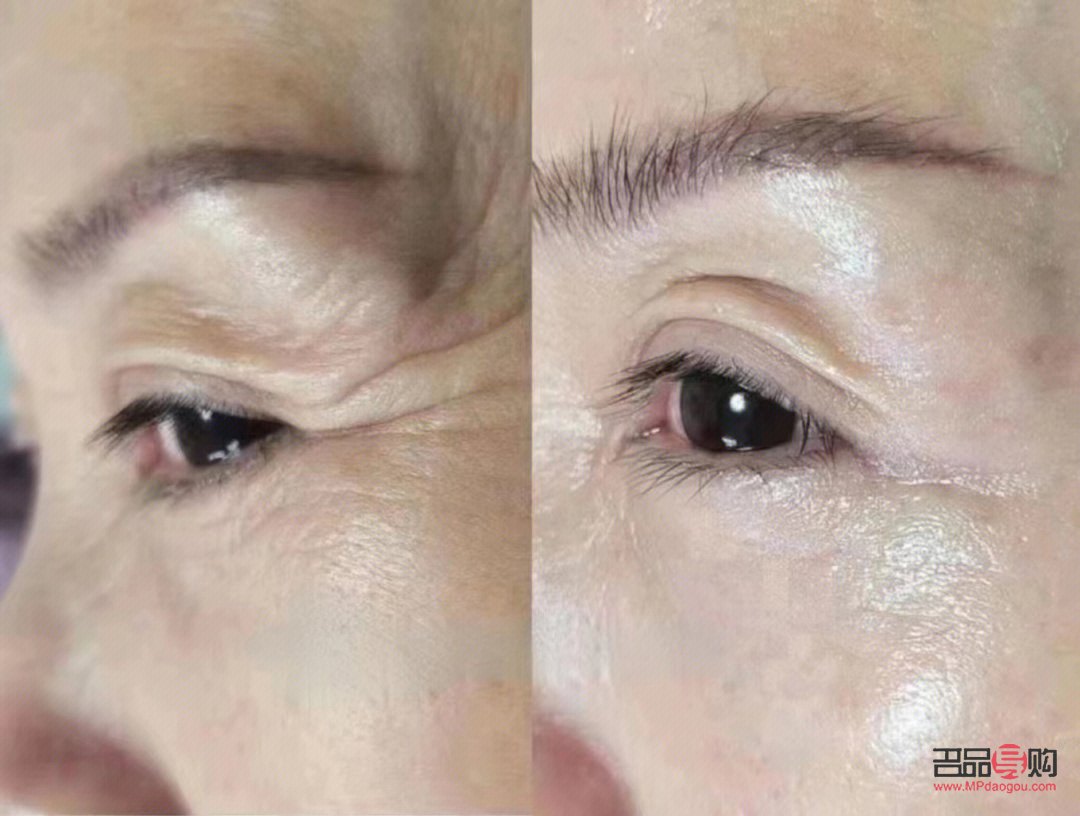 眼部除皺圖片(眼部除皺圖片大全)
