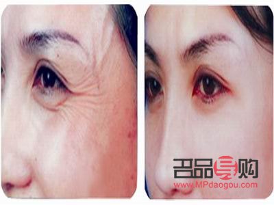 眼部除皺圖片(眼部除皺圖片大全)