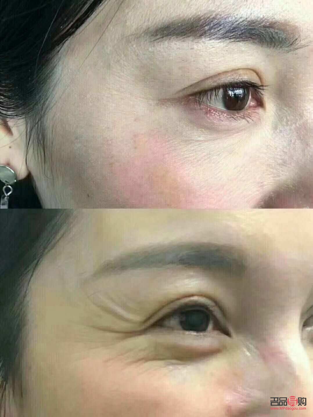 眼部除皺圖片(眼部除皺圖片大全)