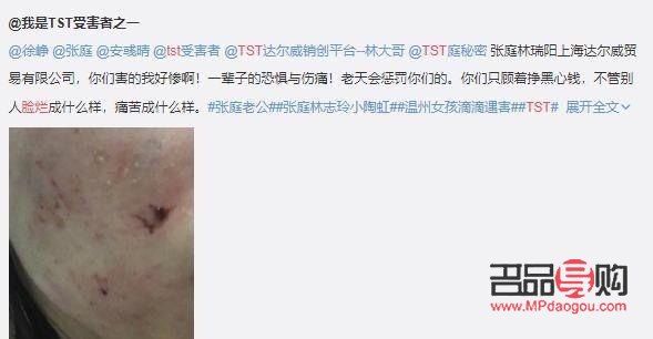 <h3>身體爛掉如何有效護(hù)理？</h3>