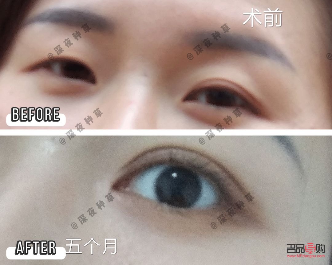 選擇割雙眼皮的最佳月份：考慮因素與建議