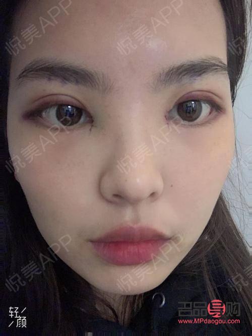 雙眼皮手術(shù)的眼綜合包括哪些項(xiàng)目(雙眼皮眼綜合手術(shù)包括什么項(xiàng)目)