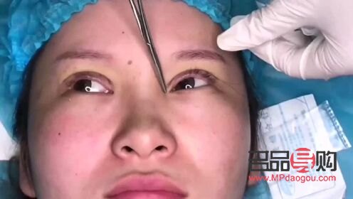 免麻雙眼皮是怎么操作的(免麻雙眼皮是什么技術(shù))