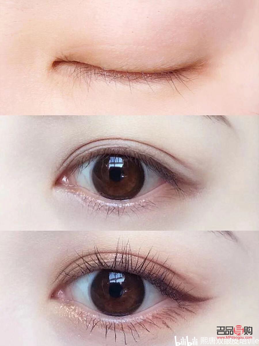 免麻雙眼皮是怎么操作的(免麻雙眼皮是什么技術(shù))