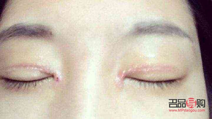 雙眼皮增生怎么辦(雙眼皮增生怎么辦多久恢復(fù))