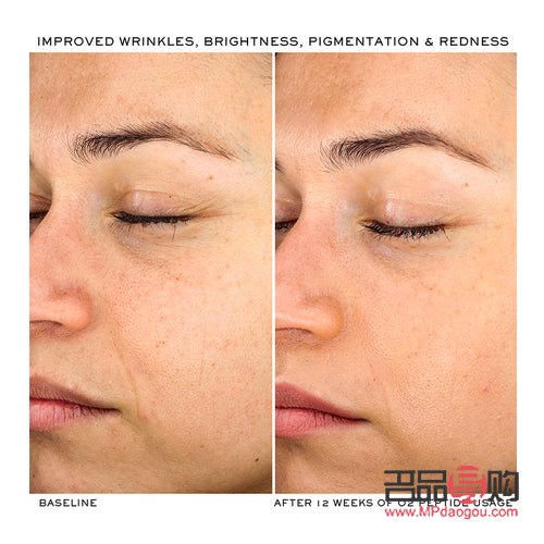 眼皮消腫后皺巴問題解決方案