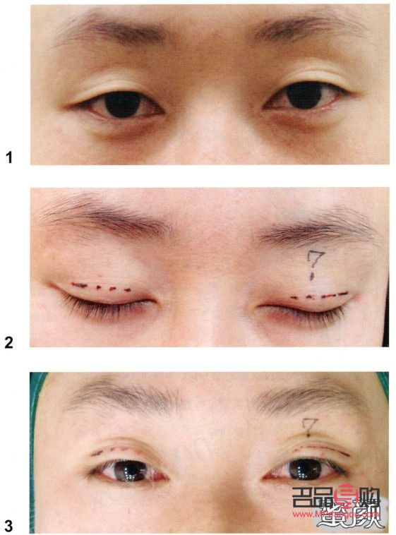 十分鐘雙眼皮(十分鐘雙眼皮技術(shù))