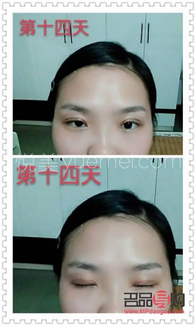 十分鐘雙眼皮(十分鐘雙眼皮技術(shù))