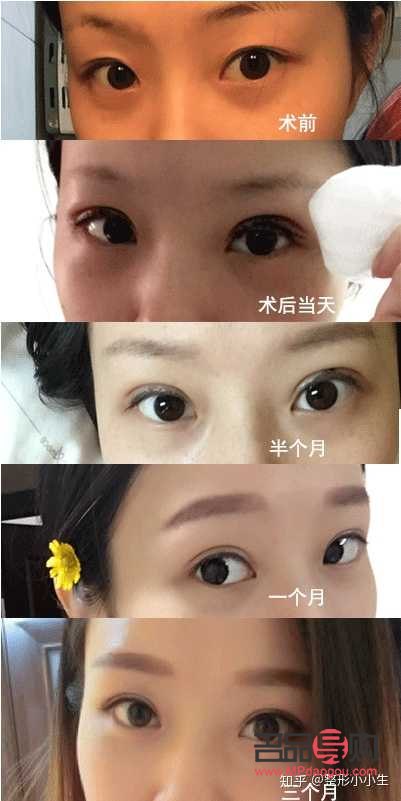 十分鐘雙眼皮(十分鐘雙眼皮技術(shù))