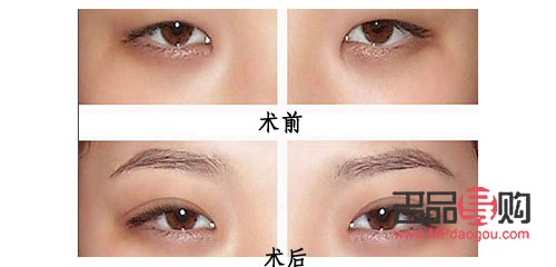 <h3>上眼皮松弛是否可以割雙眼皮？</h3>