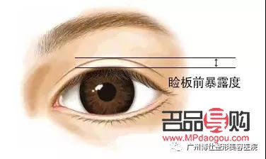 <h3>上眼皮松弛是否可以割雙眼皮？</h3>