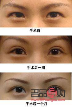 <h3>上眼皮松弛是否可以割雙眼皮？</h3>