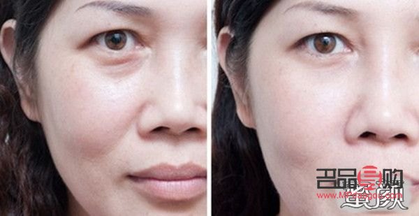 眼窩凹陷的成因及解析