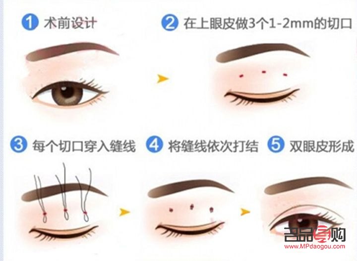 雙眼皮手術(shù)價(jià)格探究：美麗需要多少成本？