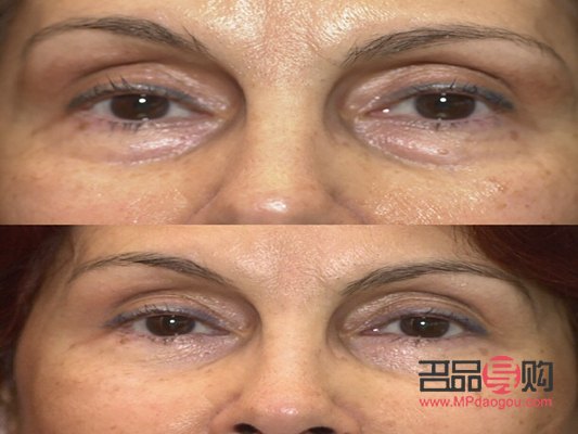 眼部抽脂后眼皮塌了怎么辦(眼部抽脂后眼皮塌了怎么辦圖片)