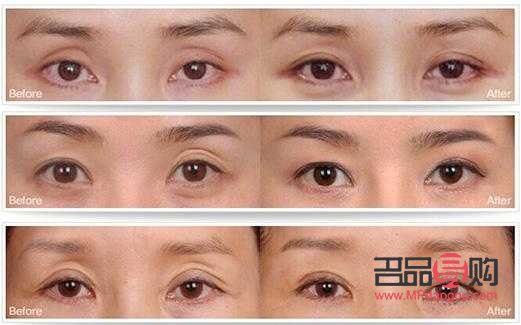 眼部抽脂后眼皮塌了怎么辦(眼部抽脂后眼皮塌了怎么辦圖片)