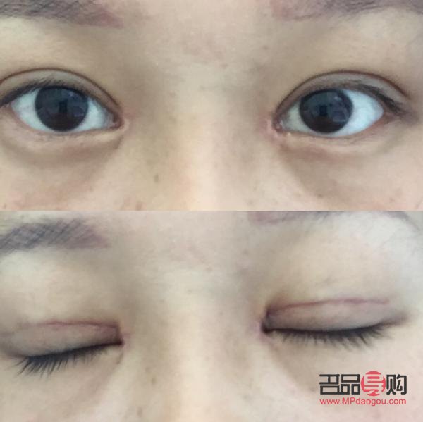 眼部抽脂后眼皮塌了怎么辦(眼部抽脂后眼皮塌了怎么辦圖片)