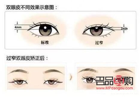 探尋最完美的雙眼皮標(biāo)準(zhǔn)