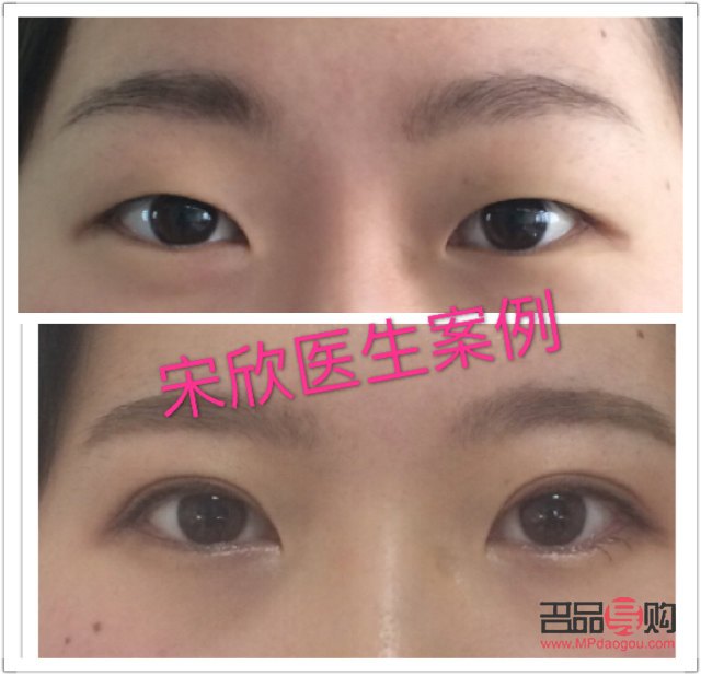 眼角下垂手術(shù)視頻(眼角下垂手術(shù)視頻教程)