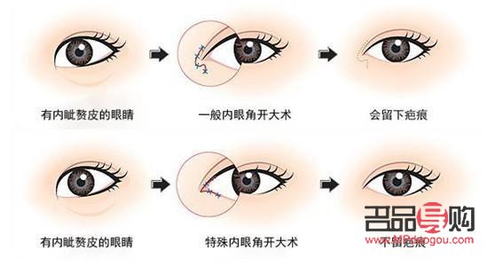 小眼綜合一般需要多少錢(小眼綜合一般需要多少錢一次)